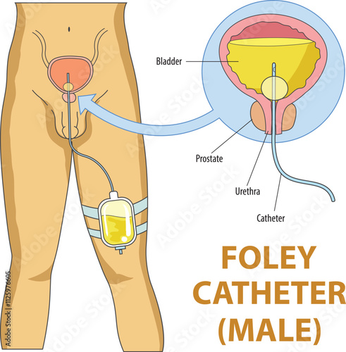 illustration of foley catheter in male diagram