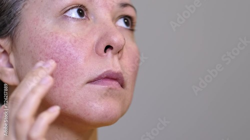 Close-up of a young woman with facial redness and couperose. Highlights skin sensitivity and inflammation, emphasizing skincare needs and dermatology treatments.