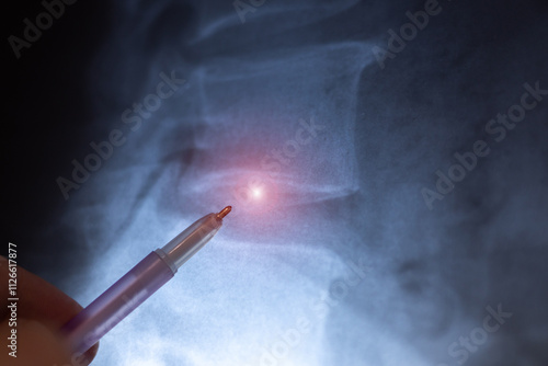 Doctor learn X-ray scan of intervertebral discs in spine. Close up.