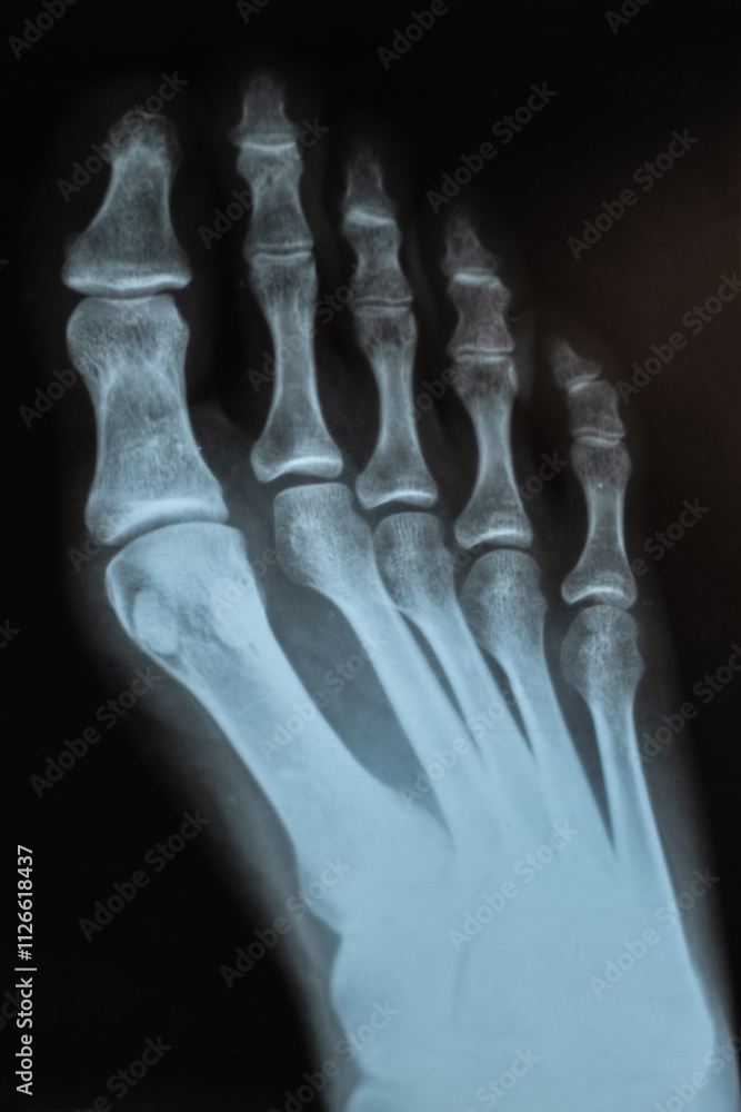 X-ray of human foot. Diseases of the phalanges fingers bones. Metatarsal phalangeal joints. Vertical image. X-ray of human foot. Diseases of the phalanges fingers bones. Metatarsal phalangeal joints. Vertical image.
