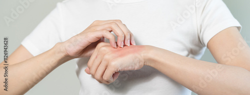 Wallpaper Mural person have red rash on arm from insect bite allergic. Torontodigital.ca