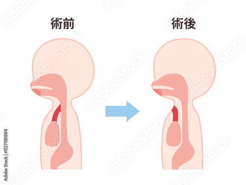 喉頭癌の術前術後の気管のイラスト