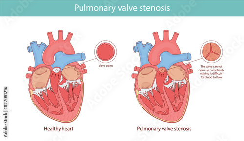 pulmonary valve stenosis. anatomical illustration