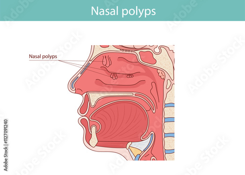 Nasal Polyps Diagram: Anatomy of the nasal cavity, sinuses, mouth, turbinates and polyps. Medical vector illustration