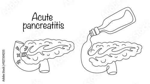 Acute pancreatitis