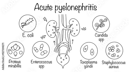 Acute pyelonephritis