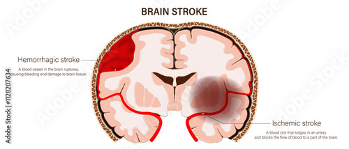 Brain stroke vector. Hemorrhagic stroke and Ischemic stroke. Brain tissue death. Human brain anatomy structure.