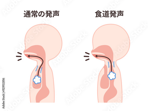 食道発声と通常の発声の仕組みのイラスト