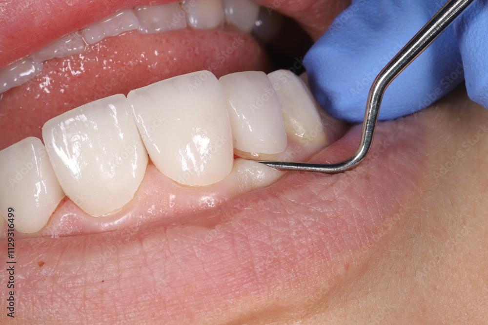 Obraz premium Restoring aesthetics and chewing function with glass-ceramic porcelain dental crowns in dental aesthetic dentistry.