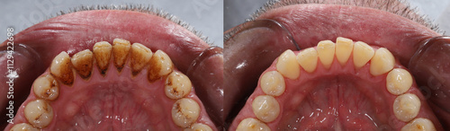 Tableau sur toile Before and after cleaning of stains and tartar on the tooth surface by a dentist in dental dentistry