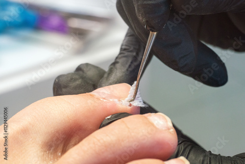 Medical pedicure, podiatrist doing tamponade to a deformed toenail photo