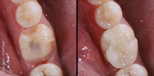 Digital production porcelain dental inlay and onlay used for enamel restoration in dental dentistry.

