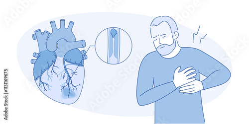 Myocardial infarction. Illustration of a human heart. Heart attack. Illustration in cartoon style