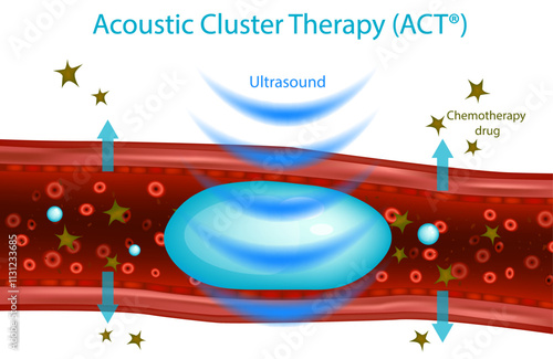Acoustic Cluster Therapy or ACT. Therapeutic ultrasound. Sonodynamic therapy