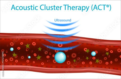 Acoustic Cluster Therapy or ACT. Therapeutic ultrasound. Sonodynamic therapy