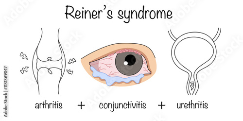 Reiter's syndrome