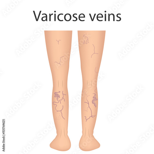The external sign of dilated skin vessels. Symptoms of vascular lesions of the legs. Varicose veins