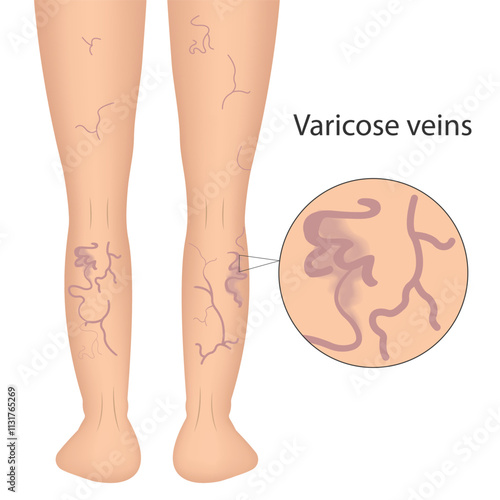 The external sign of dilated skin vessels. Symptoms of vascular lesions of the legs. Varicose veins