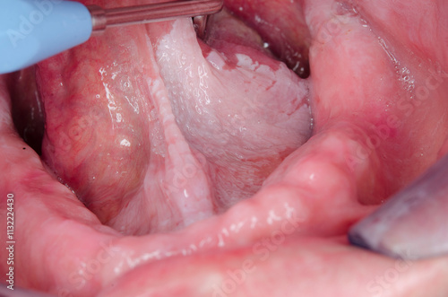 leukoplakia