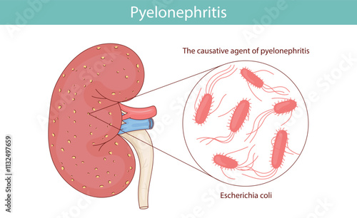 Kidney pyelonephritis, caused by Escherichia coli. vector medical illustration