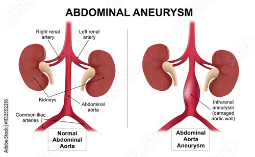 Abdominal Aortic Aneurysm Illustration weak artery