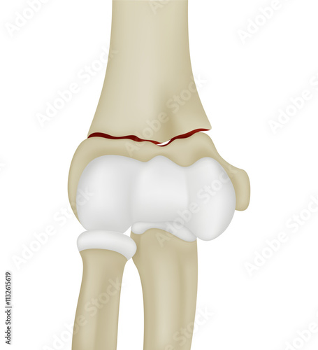 Distal Humerus Fractures of Elbow