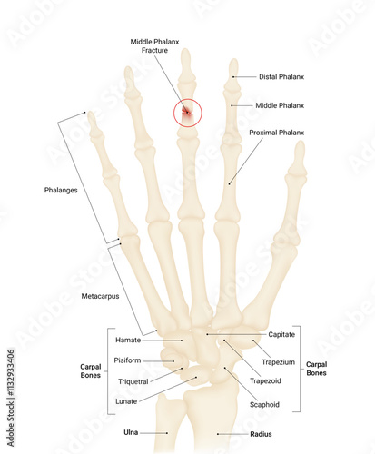 Causes of Middle Phalanx Fracture