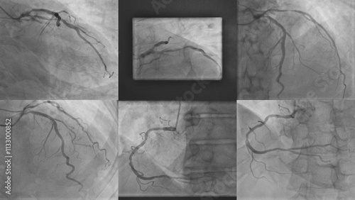 Bilde på lerret Coronary Angiogram (CAG): Evaluation of Right Coronary Artery (RCA), Left Circum