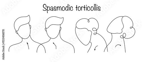 Spasmodic torticollis