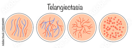 Telangiectasia