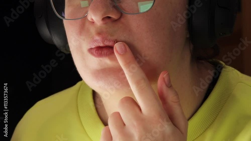Healing cold sore on lip with finger pointing at scab. Close-up of herpes blister in recovery stage. Focus on skin healing, viral outbreak treatment, and managing irrigation. 