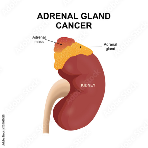 Adrenal Cancer Kidney Illustration Tumor
