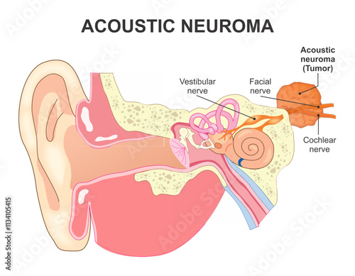 Acoustic Neuroma Tumor Illustration ENT