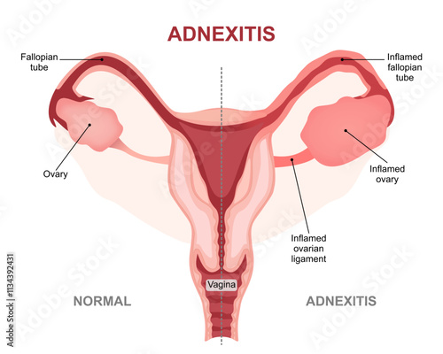 Adnexitis inflammated fallopian tubes and ovaries Illustration