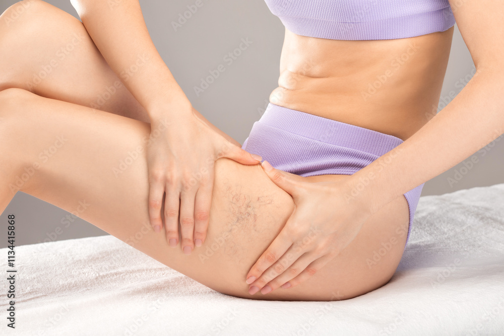 Beautiful slender woman shows varicose veins on the legs. Treatment of varicose veins and capillaries. Beautiful slender woman shows varicose veins on the legs. Treatment of varicose veins and capillaries.