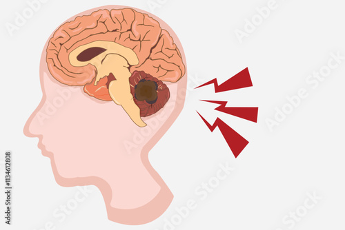 Illustration of medulloblastoma showing a malignant brain tumor in the cerebellum region. education illustration. eps 10