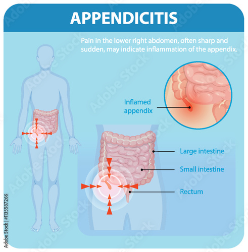 Understanding Appendicitis and Its Symptoms