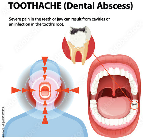 Understanding Dental Abscess and Toothache