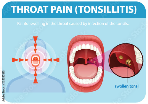 Understanding Throat Pain and Tonsillitis