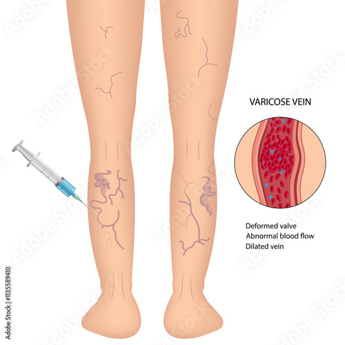 Human legs with health problems. Varicose veins. Bruise, hematoma.