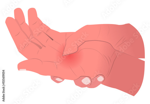 illustration of a sore palm, suitable for medical professionals, or designers who create content related to health, physical therapy, or injury prevention