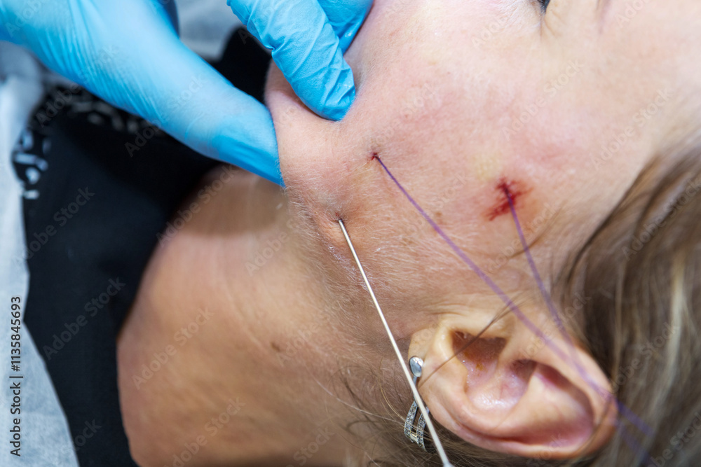 Close-up anti-age facial lifting procedure using PDO threads of polylactic acid applied in the face with aseptic cannula before extending skin Close-up anti-age facial lifting procedure using PDO threads of polylactic acid applied in the face with aseptic cannula before extending skin