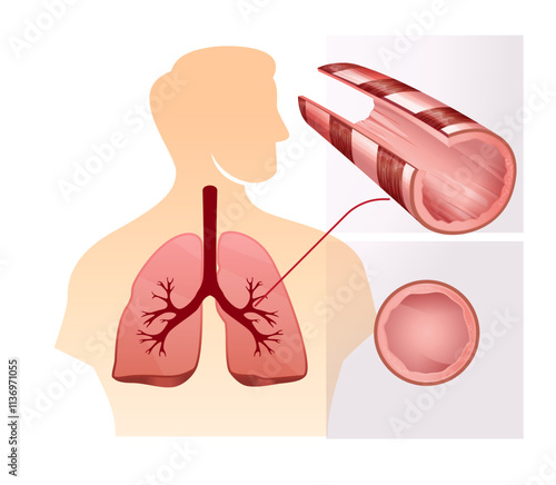 Blocked Airway in Human Lungs -  Inflamed Airway  - Illustration