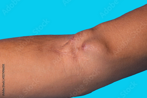 Bild auf Leinwand Fistula on the arm as a result of an operation for hemodialysis with kidney failure
