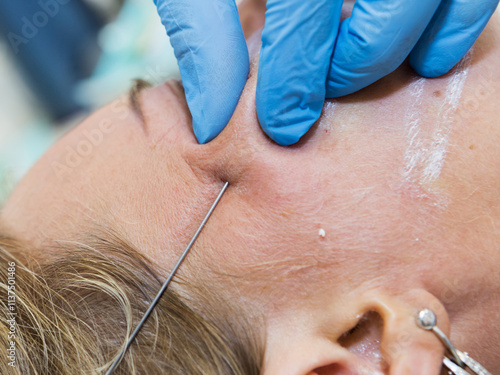 Close-up anti-age facial lifting procedure using PDO threads of polylactic acid applied in the face with aseptic cannula before extending skin