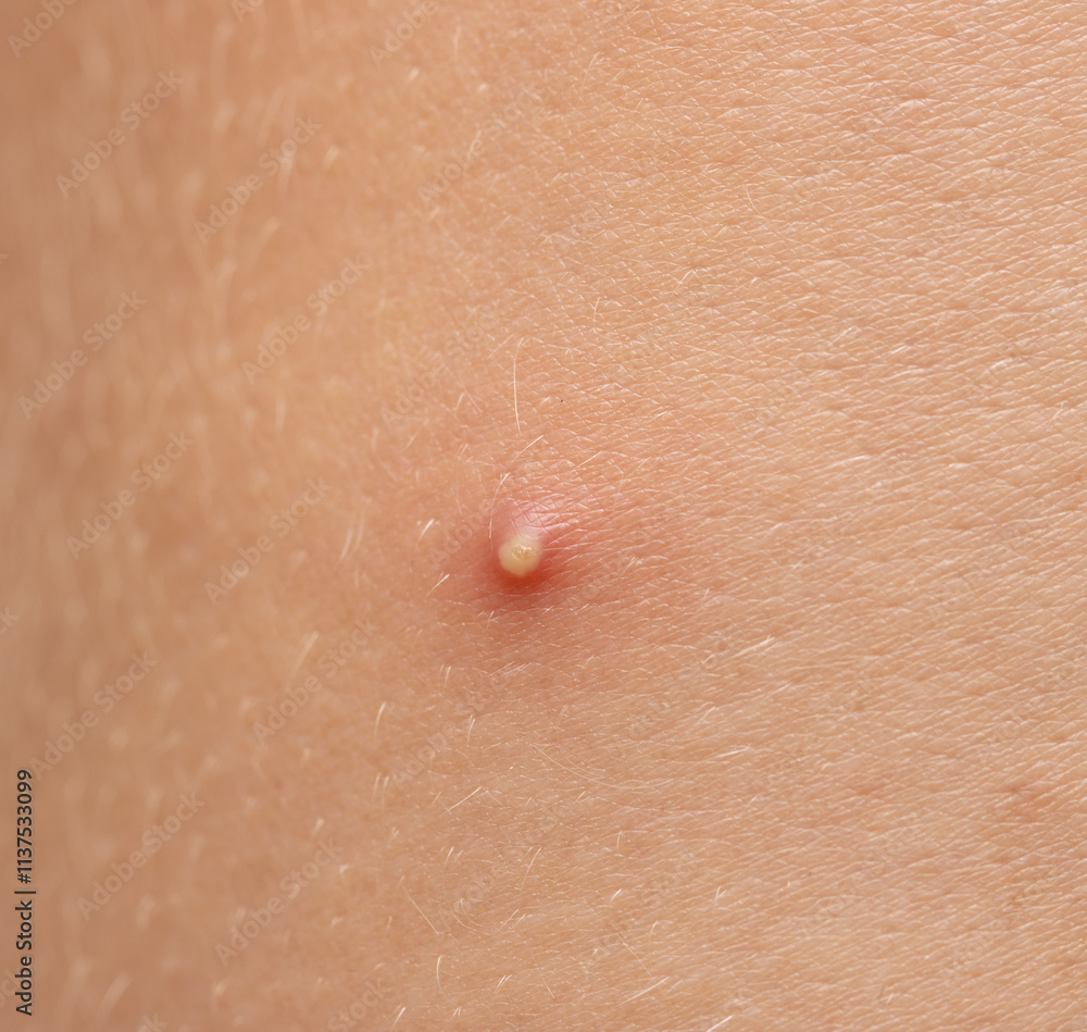 Fototapeta premium A small red bump on a person's arm