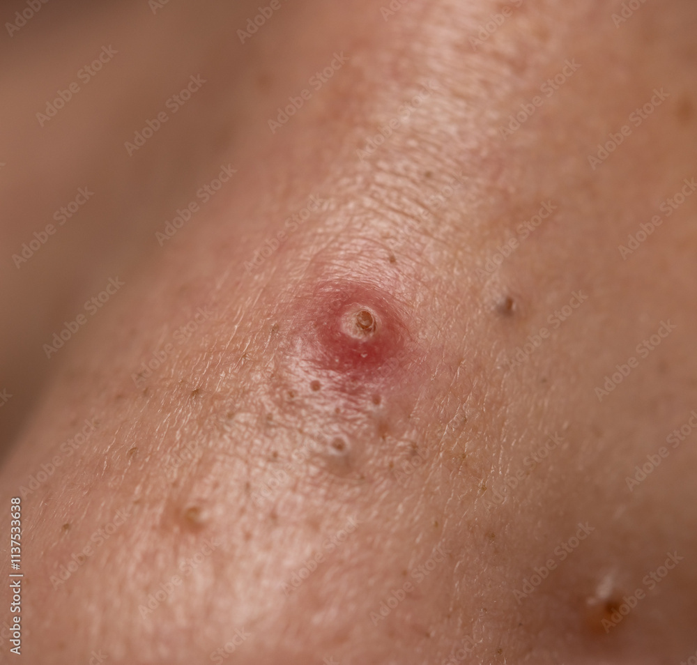 Fototapeta premium A red bump on a person's arm