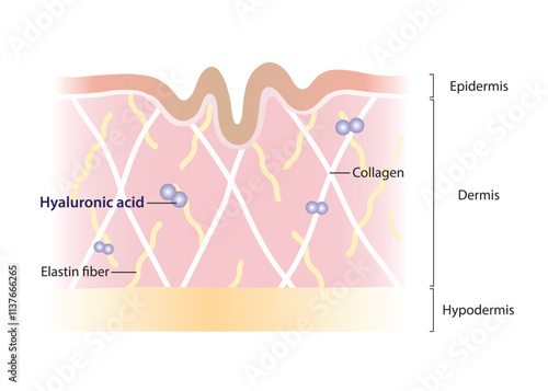 Diagram of Hyaluronic acid decrease in dermis layer vector illustration on white background. Cross section of aging skin with small amounts of shorter hyaluronic acid. Skin care and beauty concept.