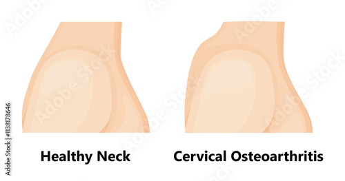 Cervical osteochondrosis and healthy neck.