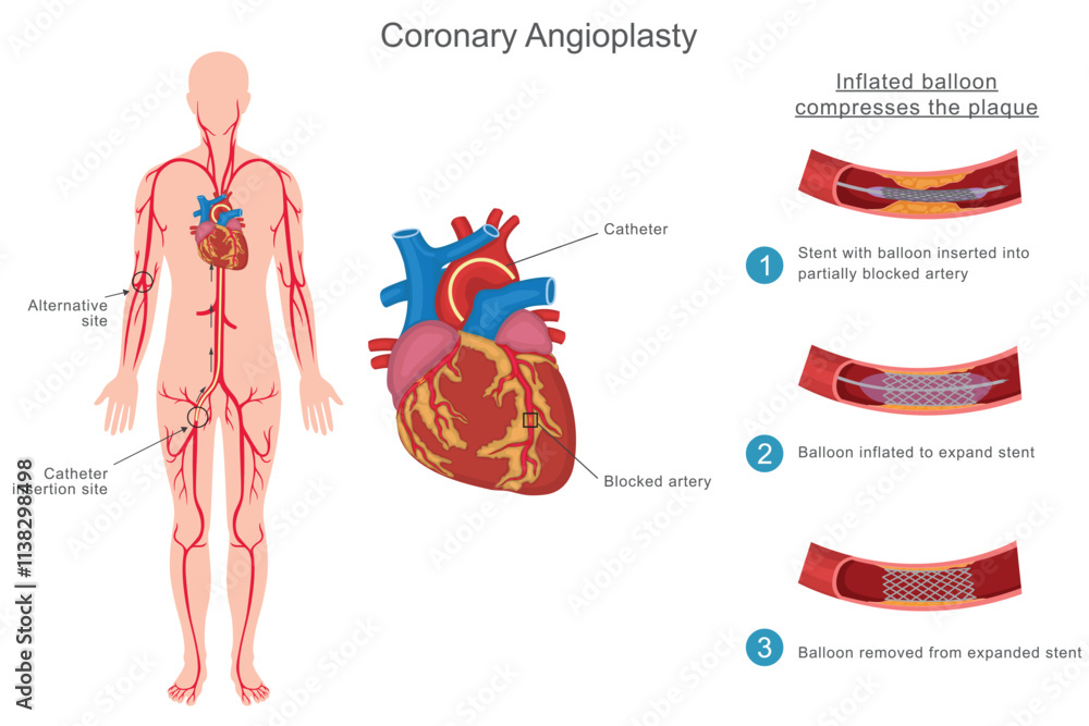Obraz premium Coronary angioplasty is a minimally invasive procedure to open blocked heart arteries using a balloon and stent, improving blood flow and reducing heart attack risk